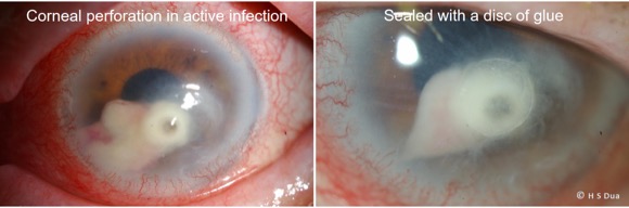 Eye surgeon in Nottingham. Corneal gluing – fibrin and cyanoacrylate. 2