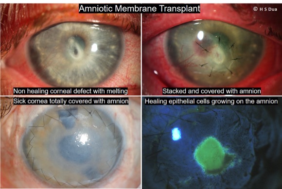 eye surgeon in Nottingham. Amniotic membrane transplant to cornea. 1