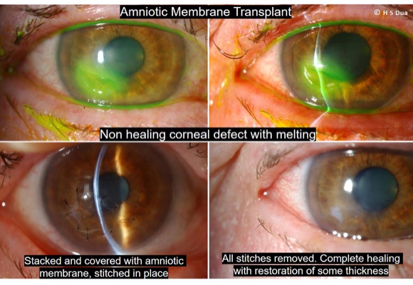 eye surgeon in Nottingham. Amniotic membrane transplant to cornea. 2