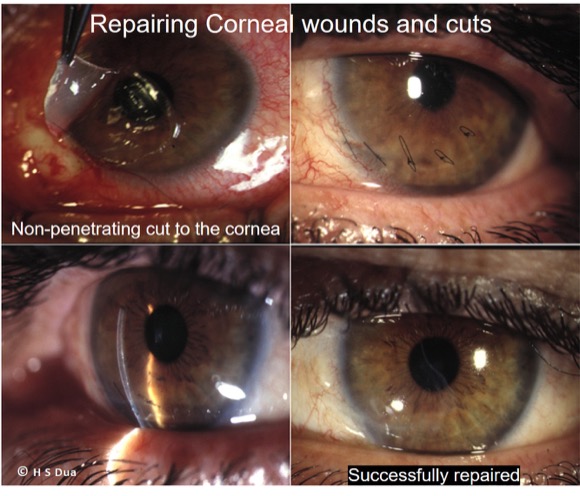 Eye surgeon in Nottingham. Repair of Lacerations. 1