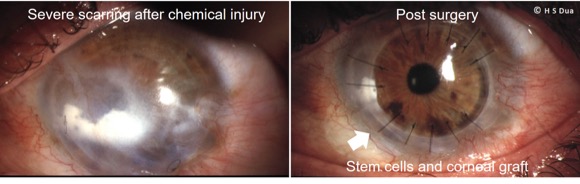 Opthalmologist in Nottingham. Limbal (Stem cell) transplantation: autologous, living related and cadaver donors. 2