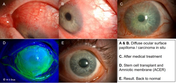 Eye doctor in Nottingham. Ocular surface reconstruction (ACER).