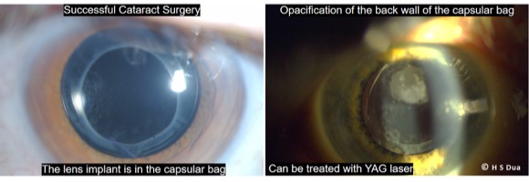 Cataract surgery. Phacoemulsification of the lens with implant.
