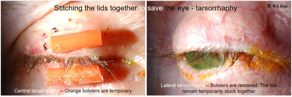 Eye surgeon in Nottingham. Tarsorrhaphy procedure.