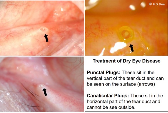 Opthalmologist and eye surgeon in Nottingham. Punctal plugs and cautery 1