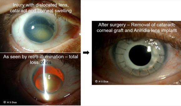 eye surgeon in Nottingham. Aniridia lens implant. 1