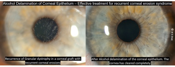 Opthalmologist in Nottingham. Alcohol delamination of corneal epithelium (ALD). 1
