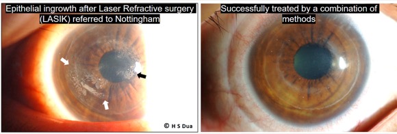 Surgery undertaken with Laser to give good sight without glasses.