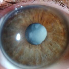 Eye Doctor Nottingham - Harminder Dua. Cataract.