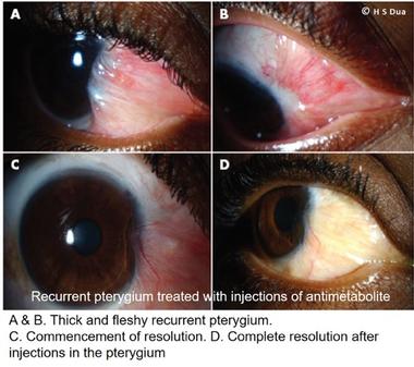 Conjunctiva issues. Excision of pinguecula and pterygium with autologous conjunctival graft. 4
