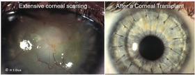Eye doctor opthalmologist. Corneal transplants: full thickness and partial thickness. Tectonic grafts. 1