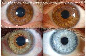 Eye doctor opthalmologist. Corneal transplants: full thickness and partial thickness. Tectonic grafts. 5
