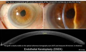 Eye doctor opthalmologist. Corneal transplants: full thickness and partial thickness. Tectonic grafts. 6