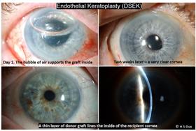 Eye doctor opthalmologist. Corneal transplants: full thickness and partial thickness. Tectonic grafts. 7