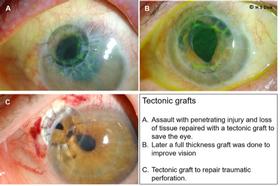 Eye doctor opthalmologist. Corneal transplants: full thickness and partial thickness. Tectonic grafts. 10