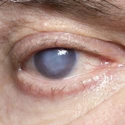 Eye Doctor Nottingham - Harminder Dua. Glaucoma.